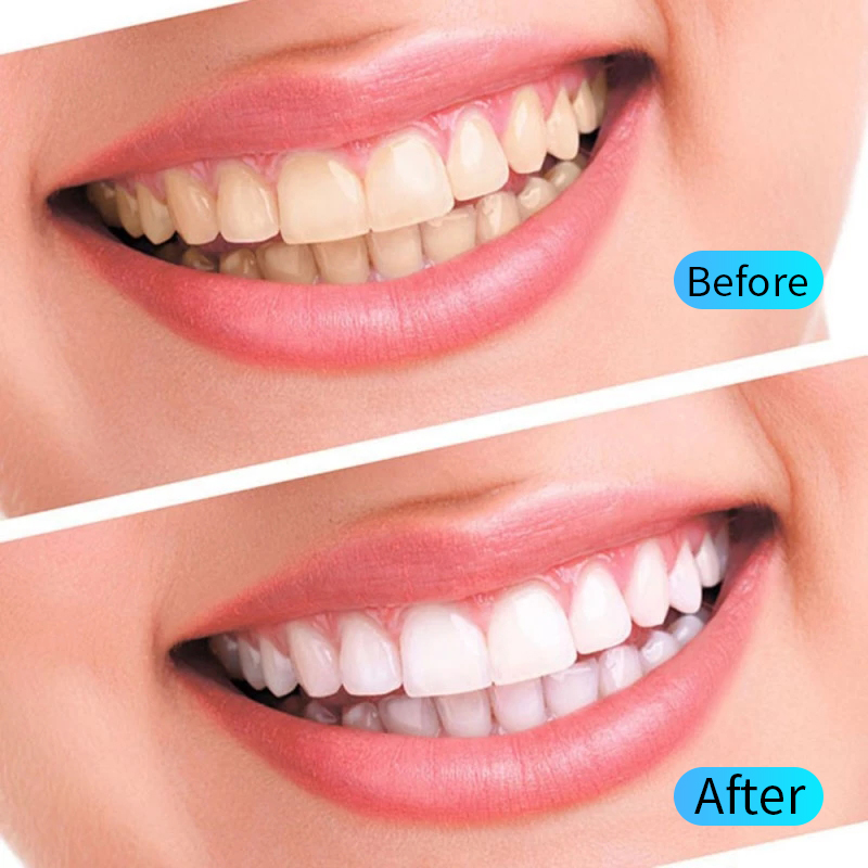 Kit de gel para clareamento de - Teeth Whitening Filter avaliação e preço