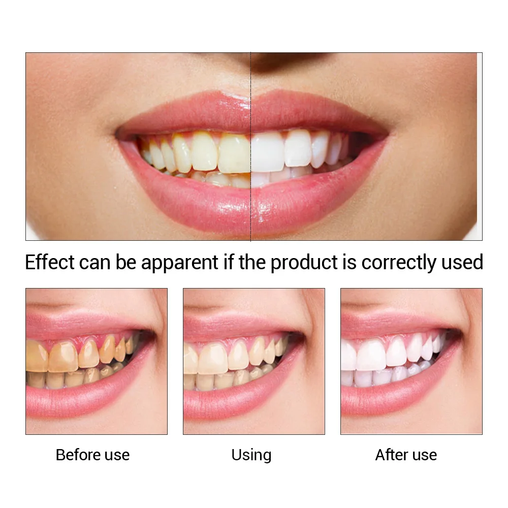 FTEENPLY Essência para claream - Teeth Whitening Best avaliação e preço