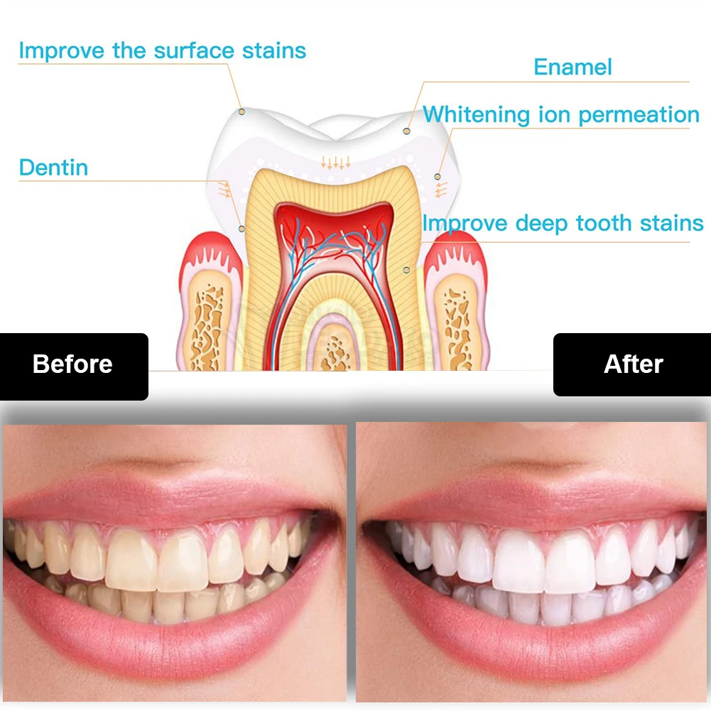 Kit de clareamento dental dos  - Teeth Whitening For Trays avaliação e preço